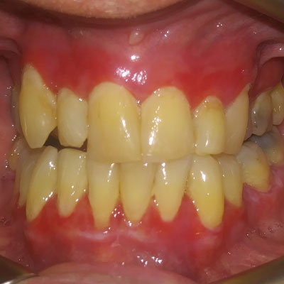 Oral Manifestations