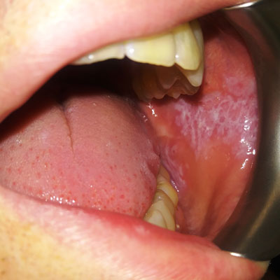 White Patches in the Mouth